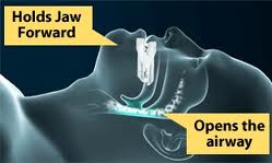 osa-airway-pic-2